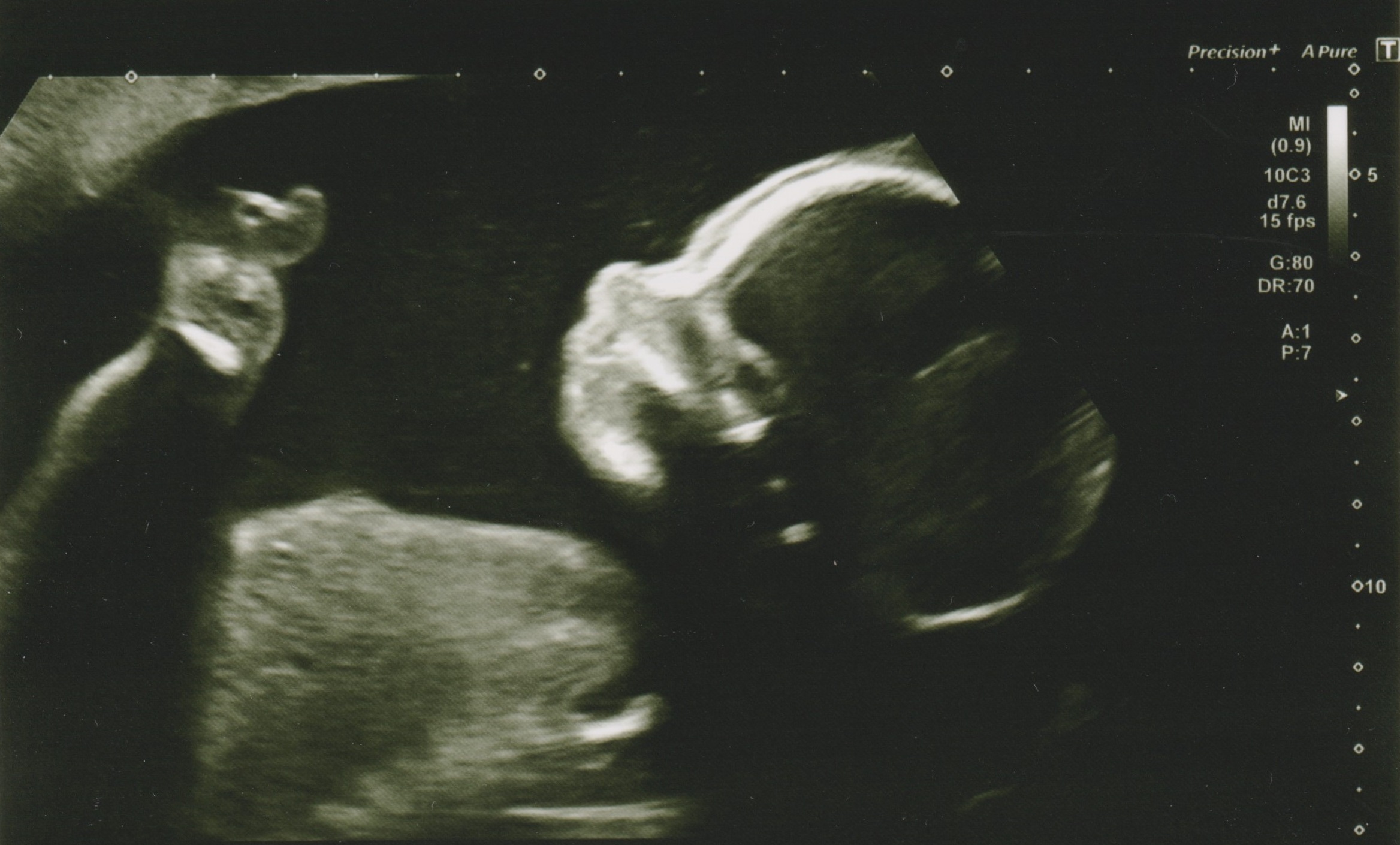 A screenshot from my wife's 20-week scan